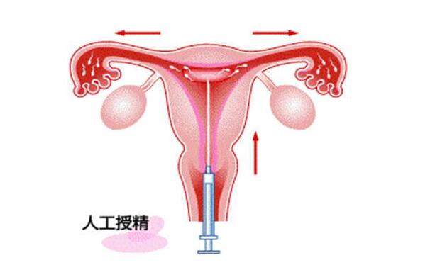 兰州试管婴儿