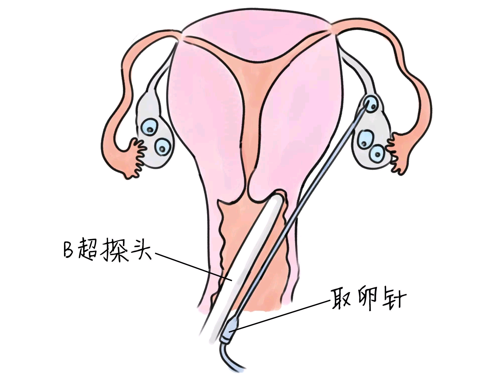 冷冻卵子