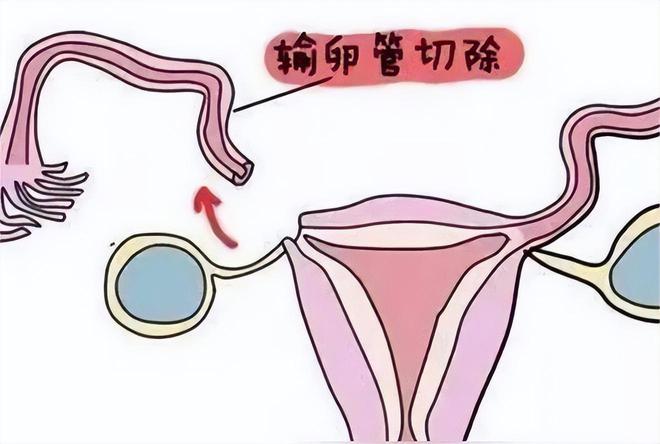 试管婴儿